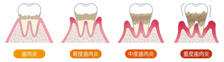 歯周病の症状